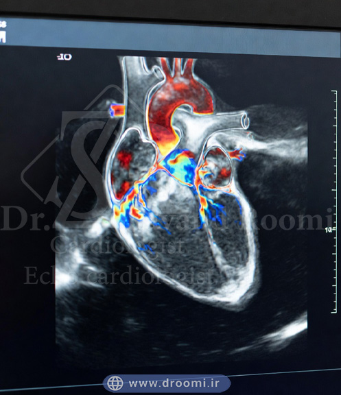 اکو داپلر رنگی قلب با نمایش جریان خون قرمز و آبی در حفره‌ها و دریچه‌های قلب روی مانیتور پزشکی
