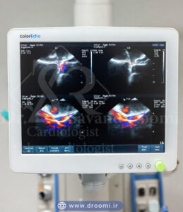 نمای نزدیک از دریچههای قلب در اکو داپلر رنگی با نمایش جریان خون آشفته
