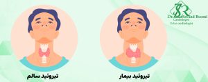 تیروئید بیش فعال