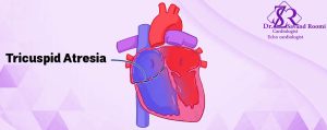 • تریکوسپید آترزی (Tricuspid Atresia): 