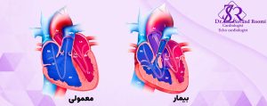 • تترالوژی فالو پیچیده