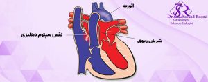 • جابه‌جایی شریان‌های بزرگ (Transposition of the Great Arteries