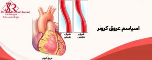 اسپاسم عروق کرونری