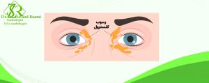 زانتلاسما (رسوبات کلسترول در پلک‌ها)