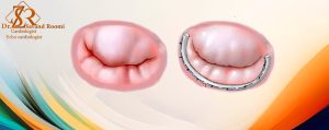 جراحی ترمیم یا تعویض دریچه‌ها