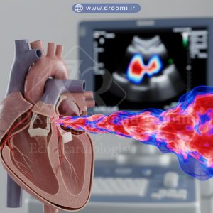 تصویر سهبعدی برشخورده قلب انسان با نارسایی دریچه میترال و نمایش جریان داپلر قرمز و آبی در کنار صفحه اکوکاردیوگرافی