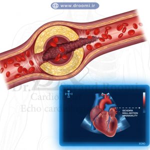 نمایش کاهش جریان خون در شریان قلب با تصویر اکوکاردیوگرافی نشاندهنده ایسکمی یا ناهنجاری حرکت دیواره