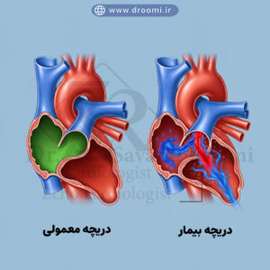 تصویر آموزشی مقایسه دریچه سالم و دریچه دارای نارسایی با اکو داپلر رنگی