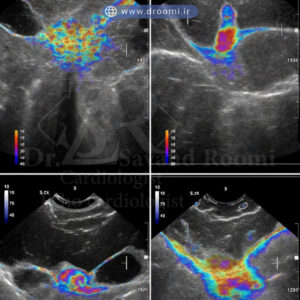 مجموعه تصاویر اکو داپلر رنگی از نارسایی میترال، تنگی آئورت و برگشت جریان دریچهای