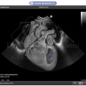 تصویر اکو قلب کودک با بزرگ‌شدن حفره‌ها و کاهش عملکرد در کاردیومیوپاتی اتساعی