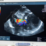 اکوکاردیوگرافی چیست