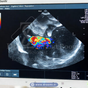 تصویر واقعی اکو داپلر رنگی