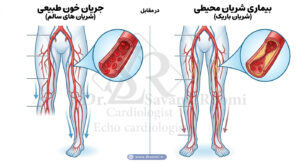 نمودار پزشکی از شریان‌های پا که یک سمت جریان خون طبیعی و سمت دیگر تنگی شریان با پلاک را نشان می‌دهد