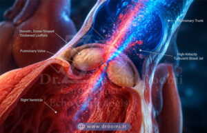 رندر پزشکی از دریچه گنبدیشکل و ضخیم پولمونر به همراه جت پرسرعت و متلاطم خون به داخل شریان ریوی
